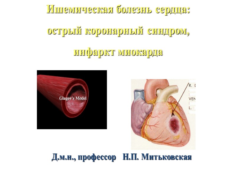 Ишемическая болезнь сердца: острый коронарный синдром, инфаркт миокарда      